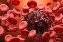 Hoa mắt, sút cân, đổ mồ hôi trộm về đêm... không ngờ mắc ung thư máu