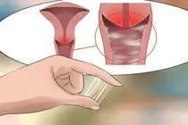 Đi khám viêm phụ khoa, bất ngờ phát hiện mắc tiền ung thư cổ tử cung