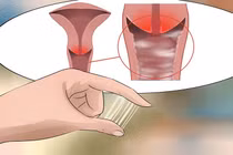 Đi khám viêm phụ khoa, bất ngờ phát hiện mắc tiền ung thư cổ tử cung