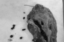 Đau bụng thượng vị và hạ sườn trái, người phụ nữ bất ngờ phải cắt gan