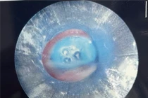 Ăn kẹo socola dạng bơm tiêm, bé trai bị sặc đầu ống vào đường thở