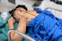 Nam thanh niên bị dị vật kim loại tự chế xuyên thấu tim