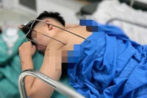 Nam thanh niên bị dị vật kim loại tự chế xuyên thấu tim