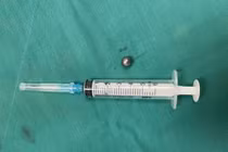 Bé trai 5 tuổi bị bi sắt đồ chơi bắn xuyên má, gãy xương mặt