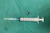 Bé trai 5 tuổi bị bi sắt đồ chơi bắn xuyên má, gãy xương mặt