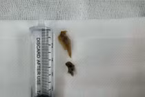 Xương vịt "trú ngụ" trong phổi bệnh nhân gần 2 năm