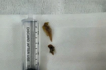 Xương vịt "trú ngụ" trong phổi bệnh nhân gần 2 năm