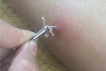 Mối nguy hiểm tiềm ẩn của bệnh giun rồng