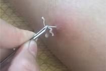 Mối nguy hiểm tiềm ẩn của bệnh giun rồng