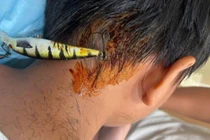 Đi câu cá, bé trai 11 tuổi bị lưỡi câu 5 cm ghim vào gáy