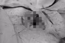 Nghẹt thở cứu sống nam thanh niên bị mảnh gỗ đâm xuyên cổ