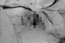 Nghẹt thở cứu sống nam thanh niên bị mảnh gỗ đâm xuyên cổ