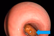 "Thủ phạm" khiến bé trai ho sặc sụa, khó thở, môi tái