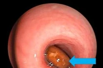 "Thủ phạm" khiến bé trai ho sặc sụa, khó thở, môi tái