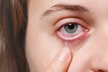 Ngứa, chảy nước mắt suốt nửa năm, đi khám phát hiện ký sinh trùng