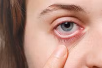 Ngứa, chảy nước mắt suốt nửa năm, đi khám phát hiện ký sinh trùng