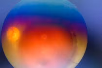 Tổn thương mắt do tia sáng laser trong đám cưới