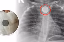 Dị vật pin cúc - hiểm họa khôn lường với trẻ em