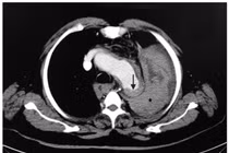 Một cú hắt hơi khiến nam Việt kiều... vỡ phình động mạch chủ
