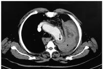 Một cú hắt hơi khiến nam Việt kiều... vỡ phình động mạch chủ