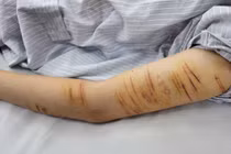 Nữ sinh 15 tuổi tự rạch tay để... giải tỏa stress