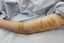 Nữ sinh 15 tuổi tự rạch tay để... giải tỏa stress