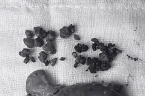 Mẩn ngứa suốt 2 năm, người phụ nữ bất ngờ phải cắt gan 