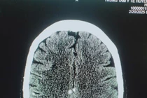 Chi chít sán từ chân tới não vì... sở thích ăn đồ sống