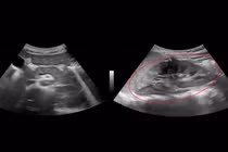 Bé trai 9 tuổi tổn thương thận do... lupus ban đỏ