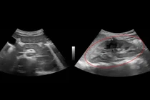 Bé trai 9 tuổi tổn thương thận do... lupus ban đỏ