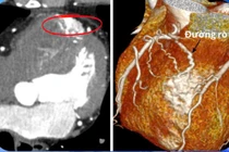Hồi hộp, tức ngực, đi khám phát hiện bất thường ở tim