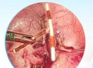 Người phụ nữ bị vòng tránh thai đâm thủng tử cung