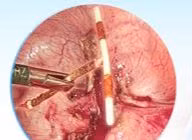 Người phụ nữ bị vòng tránh thai đâm thủng tử cung