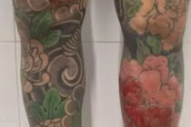 Nam thanh niên nhập viện vì biến chứng do xăm hình