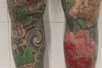 Nam thanh niên nhập viện vì biến chứng do xăm hình