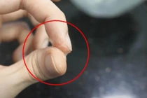 Tay dính keo 502 làm sao để gỡ một cách an toàn, nhanh chóng?