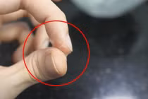 Tay dính keo 502 làm sao để gỡ một cách an toàn, nhanh chóng?