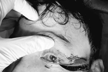 Đi câu cá, người đàn ông bị lưỡi câu móc vào nhãn cầu