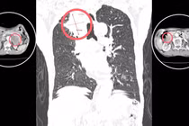 Phát hiện 3 khối u sau 30 năm không khám sức khỏe