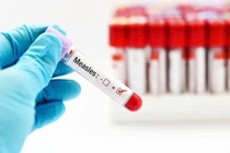 Sốt cao, gai rét thành cơn... đi khám mắc sởi bội nhiễm kèm viêm loét họng 