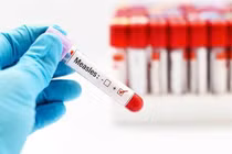 Sốt cao, gai rét thành cơn... đi khám mắc sởi bội nhiễm kèm viêm loét họng 