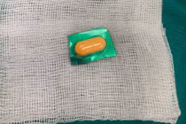 Viên thuốc còn nguyên vỏ sắc nhọn trong thực quản bệnh nhân 33 tuổi