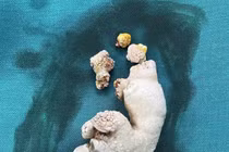 Sỏi san hô lấp đầy thận phải người phụ nữ 65 tuổi