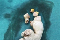 Sỏi san hô lấp đầy thận phải người phụ nữ 65 tuổi