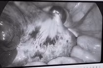 Đau bụng, nôn ói, bé gái 9 tuổi không ngờ mắc u buồng trứng xoắn