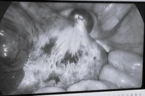 Đau bụng, nôn ói, bé gái 9 tuổi không ngờ mắc u buồng trứng xoắn