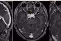 Đau nửa đầu, đi khám bất ngờ phát hiện mắc bệnh nguy hiểm ở não