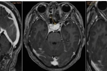 Đau nửa đầu, đi khám bất ngờ phát hiện mắc bệnh nguy hiểm ở não