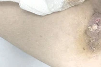 Người đàn ông 36 tuổi nguy kịch do nhiễm "vi khuẩn ăn thịt người"