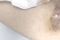 Người đàn ông 36 tuổi nguy kịch do nhiễm "vi khuẩn ăn thịt người"